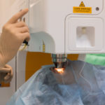 Laserová operácia očí a jej hlavné benefity